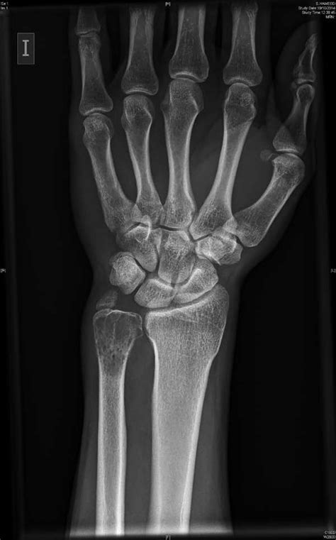 Ulna Fracture X Ray