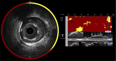 Near Infrared Spectroscopy NIRS Combining IVUS Imaging With The