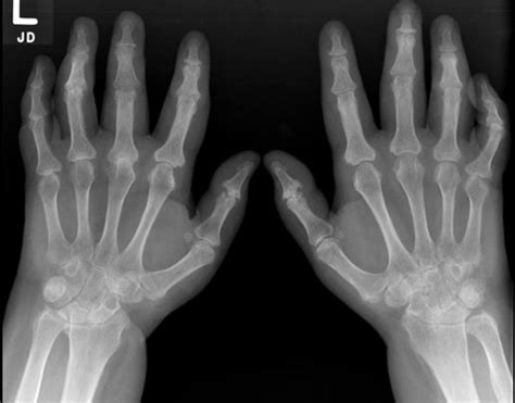 Psoriatic Arthritis X Ray Check More At Nhprimecare Org