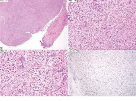 Figure From Cutaneous Involvement Of Igg Disease Cutaneous