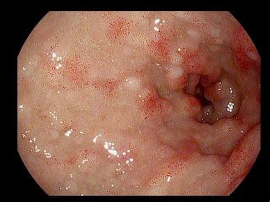 Hereditary Hemorrhagic Telangiectasia Endoscopy