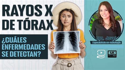 Radiografia De Torax Importancia De Este Examen Dra Jovel Especialista En Radiologia Youtube