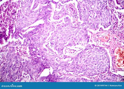 Lung Adenocarcinoma Light Micrograph Stock Photo Image Of Sample