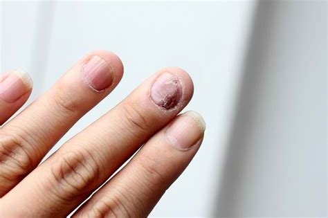 Gejala Psoriasis Kuku Dan Langkah Pengobatannya Alodokter