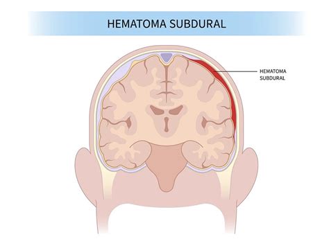 Hematoma subdural agudo En qué consiste la causa de muerte de Akira