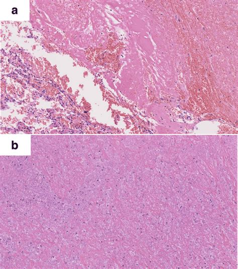 Histopathology Of The Lesion Tissue Retrieved In The Incisional Biopsy