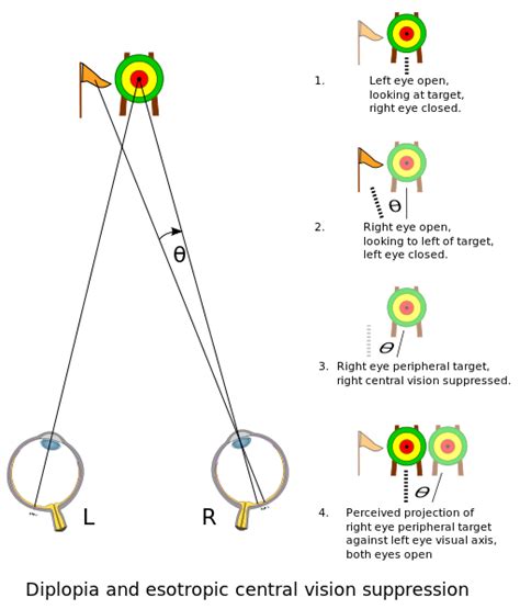 Diplopia Physiopedia