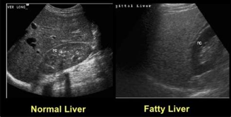 Liver Pathology Flashcards Quizlet