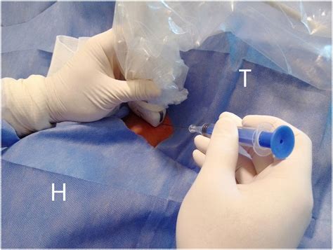 Short Axis In Plane Ultrasound Guided Technique For Internal Jugular Vein Cannulation Journal