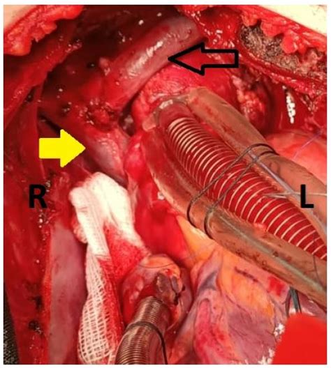 Direct Anastomosis Of Persistent Left Superior Vena Cava To Right