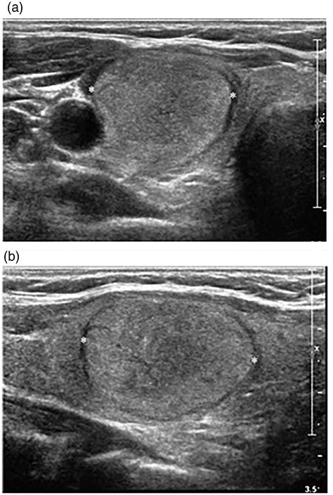 Radiofrequency Ablation Of Solid Non Functional Thyroid Nodules Techniques In Vascular