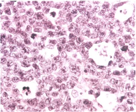 Photomicrograph Showing The Typical Appearance Of Burkitt S Lymphoma In