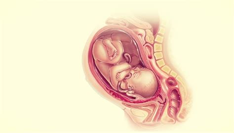 Pregnancy Complications: Placenta Accreta | Pregnant Life