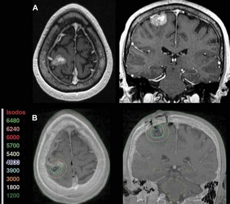 The Role Of Gammatile In The Treatment Of Brain Tumors A Technical And