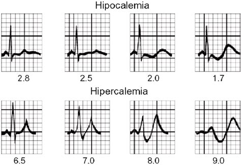 Hypokalemia ECG Changes With Examples Manual Of Medicine 56 OFF