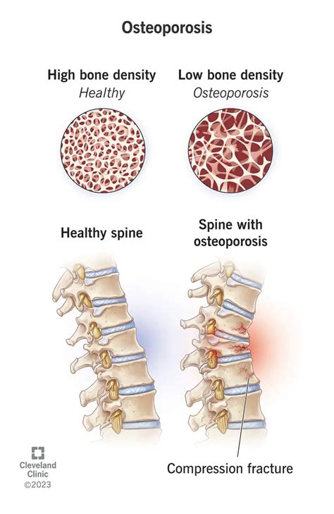 Osteoporoos S Mptomid P Hjused Ja Ravi Sfomc