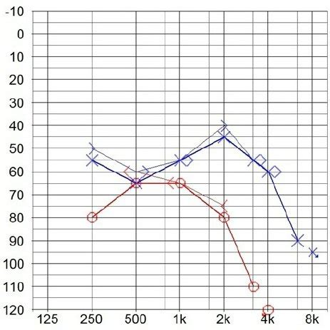 Second Pure Tone Audiogram Shows Pejoration Of Sensorineural Hearing