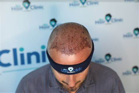 Removing Scabs After A Hair Transplant Bio Hair Clinic