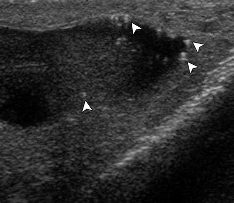 Us Of The Tunica Vaginalis Testis Anatomic Relationships And Pathologic Conditions Radiographics