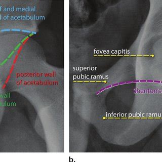 Annotated Radiographs Show The Normal Anatomy Of The Hip A The