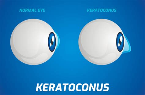 Can Keratoconus Be Cured Eye Health Optical Illusions