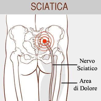 Nervo Sciatico Infiammato