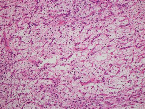 Nasopharyngeal Angiofibroma Histology