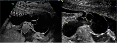 Antenatal And Histological Diagnostics Of Cystic Sacrococcygeal Teratoma Clinical Case And