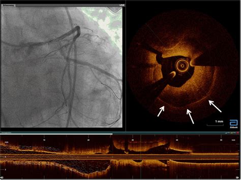 Frontiers Intravascular Imaging In Coronary Stent Restenosis