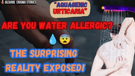 Aquagenic Urticaria Water Allergy Rare Medical Case 2023