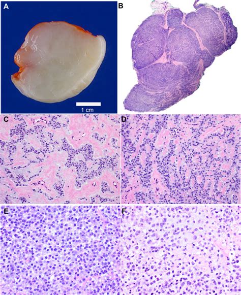 ALK Rearranged Epithelioid Mesenchymal Neoplasm Expanding The Spectrum