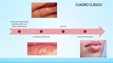 Virus Del Herpes Simple Tipo 1 Y 2 Ppt