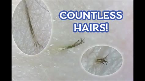 Pili Multigemini Hairs 2 Ingrown Feather Hairs Microscopic Youtube