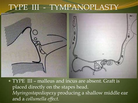 Tympanoplasty; Indications, types, anesthesia, surgical procedure. | PPT