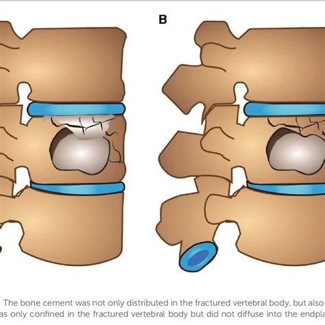 In group A, a patient with L2 vertebral fracture with upper endplate ...