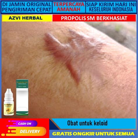 Jual Obat Keloid Obat Keloid Menahun Obat Keloid Obat Pengempis Daging