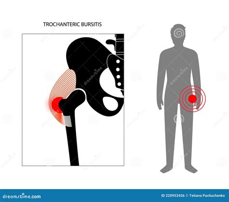 Bursitis Inflamación Concepto Ilustración del Vector Ilustración de