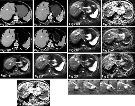 (A–N) Female patient aged 36 Y. with atypical hemangioma (showing ...