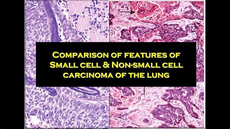 10c Difference Between Small Cell Carcinoma And Nonsmall Cell Carcinoma Youtube