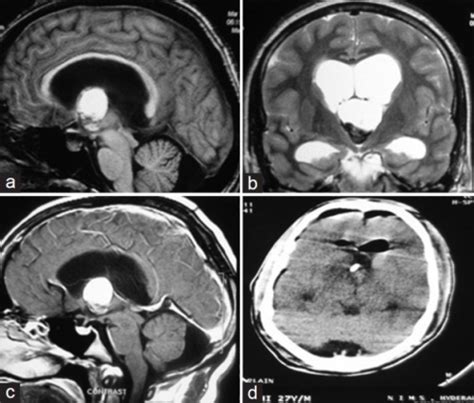 Mri T1w Sagittal A T2w Coronal B T1 Contrast Sagittal C Images