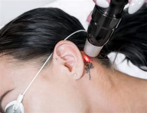 Borrar tatuajes con láser Clínica Estética Girona