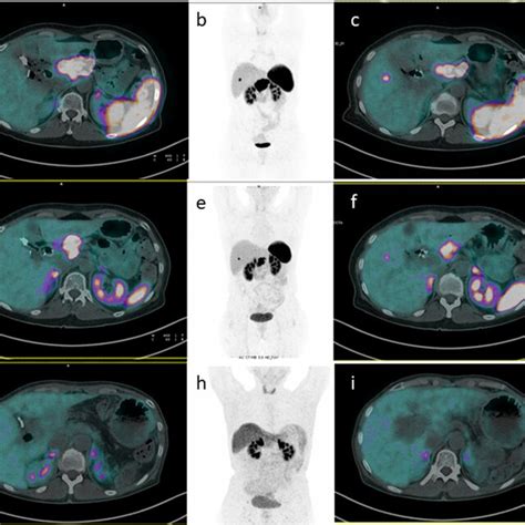 A successful case of neoadjuvant RLT ac Baseline ⁶⁸Ga DOTATOC PET CT