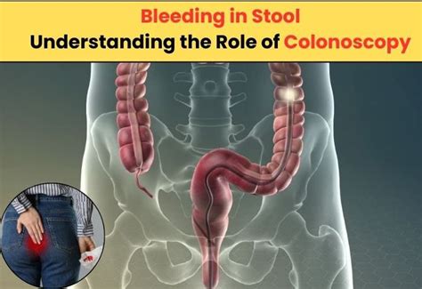 Understanding The Difference Between Endoscopy And Colonoscopy