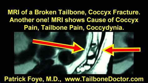 Mri Of Broken Tailbone Coccyx Fracture See What The Radiologist