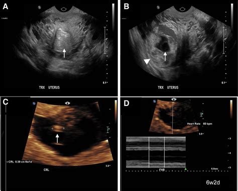 Acquired Uterine Arteriovenous Malformation In A Patient Wit Medicine