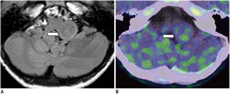 Imaging Spectrum And Pitfalls Of C Methionine Positron Emission