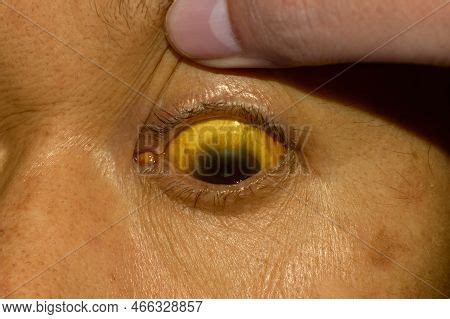 Deep Jaundice Asian Image Photo Free Trial Bigstock