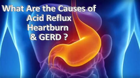 The Cause Of Acid Reflux Heartburn And Gerd Ask Nurse Mary