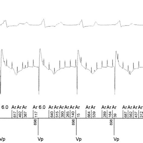 Intracardiac Electrocardiograms Obtained From The Pacemaker Download Scientific Diagram