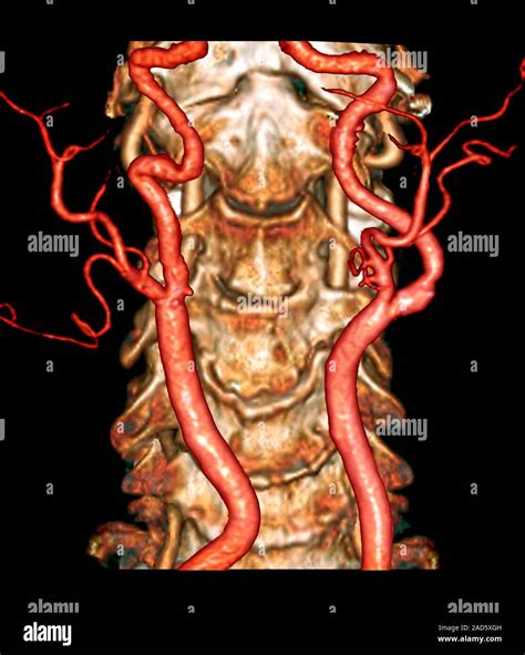 Carotid Artery Disease Coloured 3d Computed Tomography Ct Scan And Angiogram Showing A